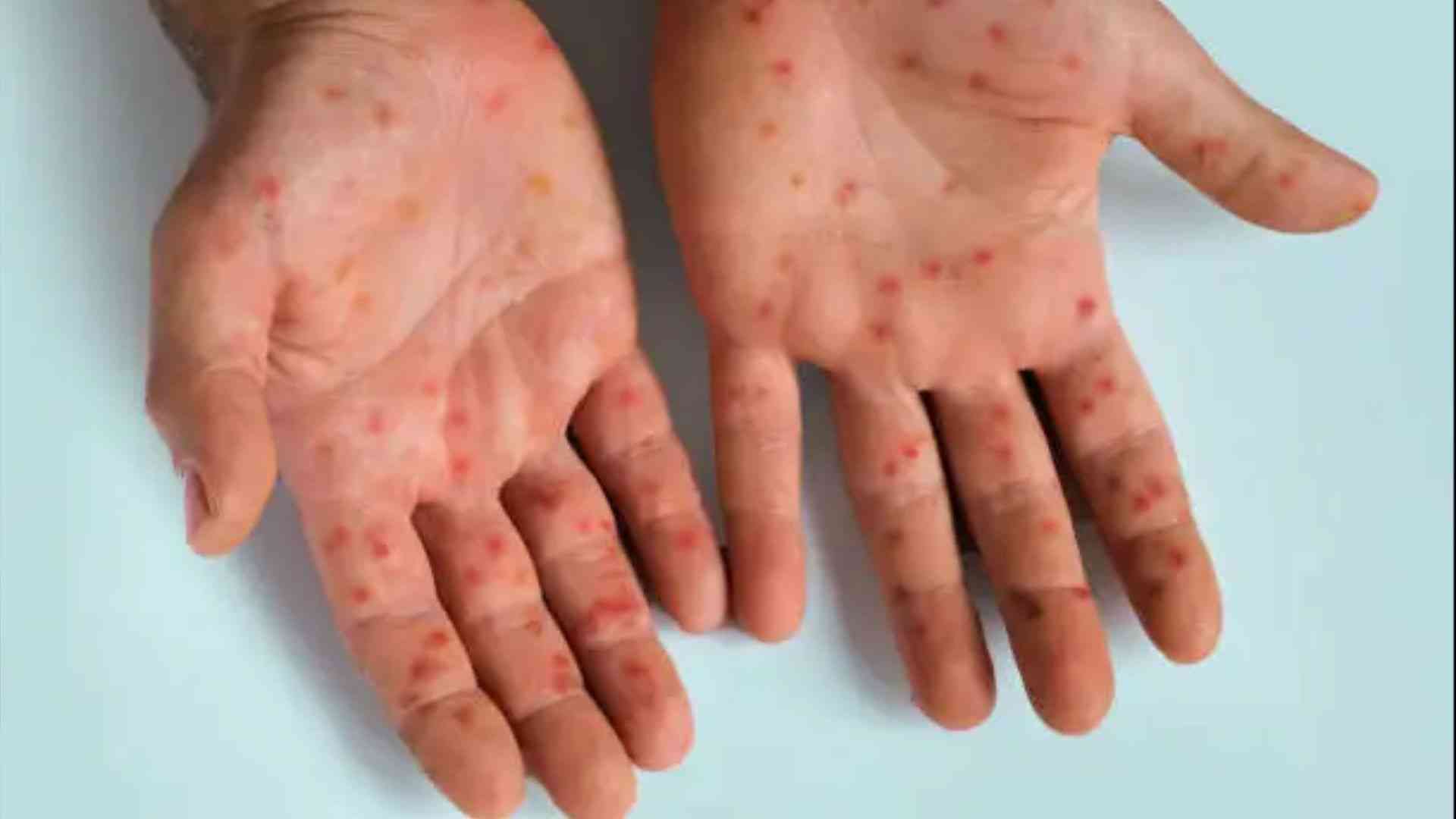 2 more mpox cases recorded, active cases raised to 5