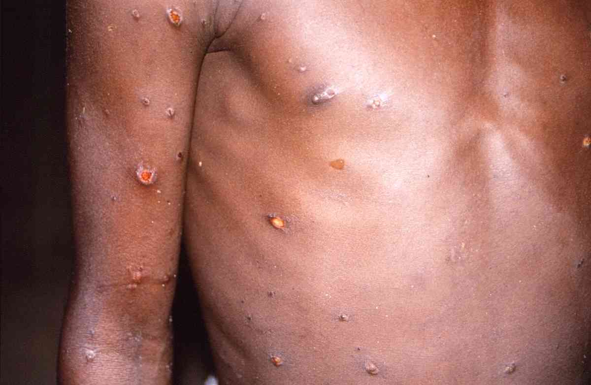 PH confirms 4th case of monkeypox