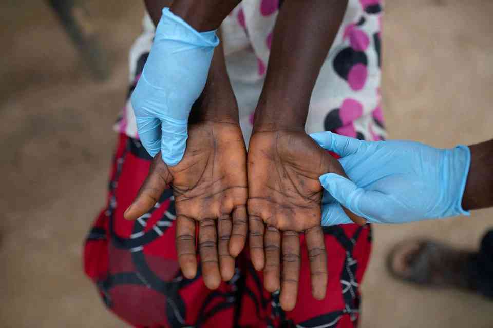 WHO to use 'mpox' for monkeypox to tackle stigma