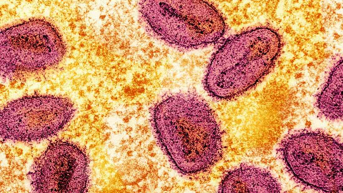 Mpox case detected in Mandaluyong; contact tracing underway