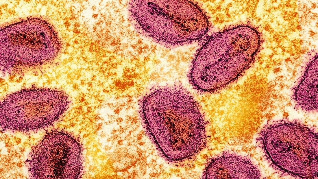 Mpox case detected in Mandaluyong; contact tracing underway
